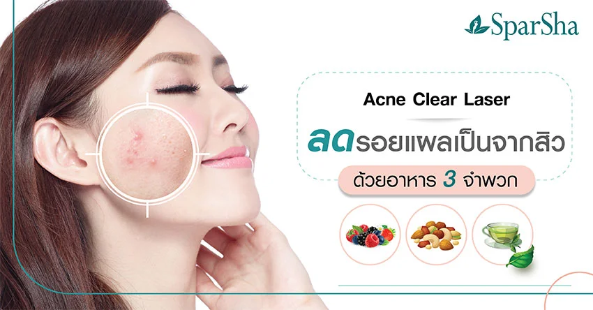 Acne Clear Laser ลดรอยแผลเป็นจากสิวด้วยอาหาร 3 จำพวก