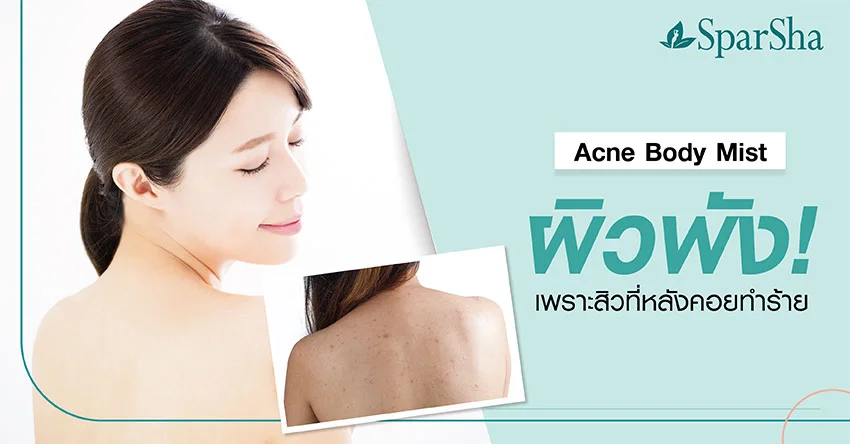 Acne Body Mist ผิวพังเพราะสิวที่หลังทำร้าย