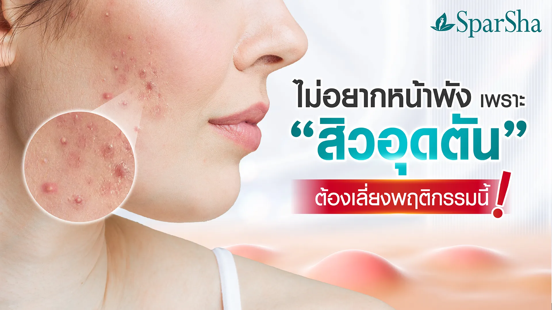 สิวอุดตัน
